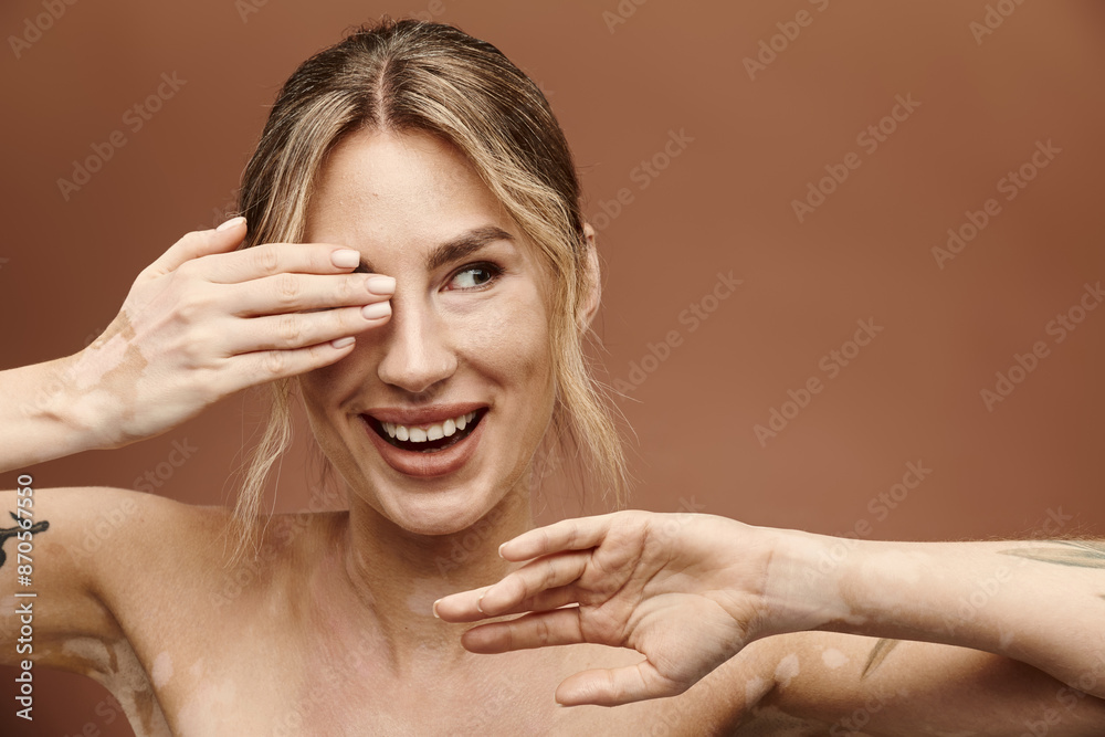Obraz premium A young woman with vitiligo poses with her bare shoulders, smiling while covering one eye with her hand.
