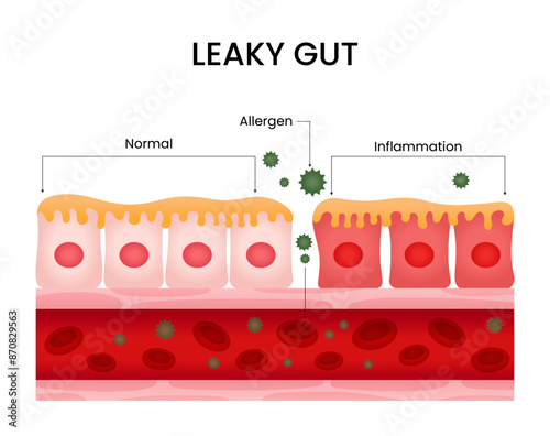 Normal Gut and Leaky Gut Vector