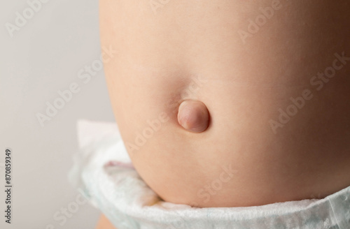 Umbilical hernia in a newborn baby on the stomach. Treatment of umbilical hernias in children without surgery, medical. Close-up