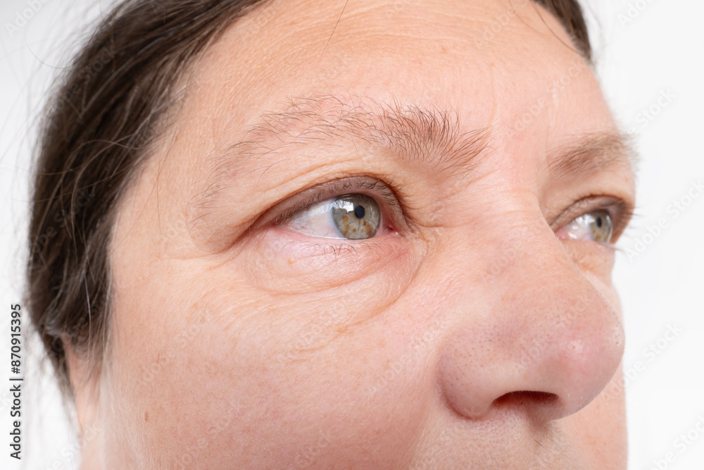 Obraz premium Puffy eyes of elderly Caucasian 55-year-old woman in close-up, swollen eyelids, medical issues and treatment options related to eye puffiness, health issues related to aging