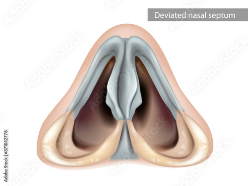 Deviated Nasal Septum. Nose, nasal cavity. Inferior view