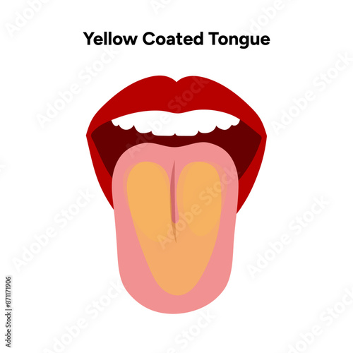 Yellow coated tongue