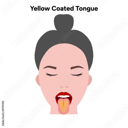 Yellow coated tongue