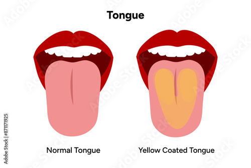 Normal and Yellow coated tongue