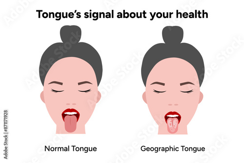 Geographic and normal tongue 