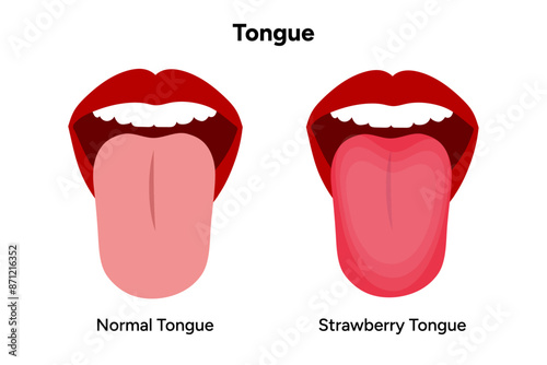 Scarlet fever tongue symptoms, normal and strawberry tongues 