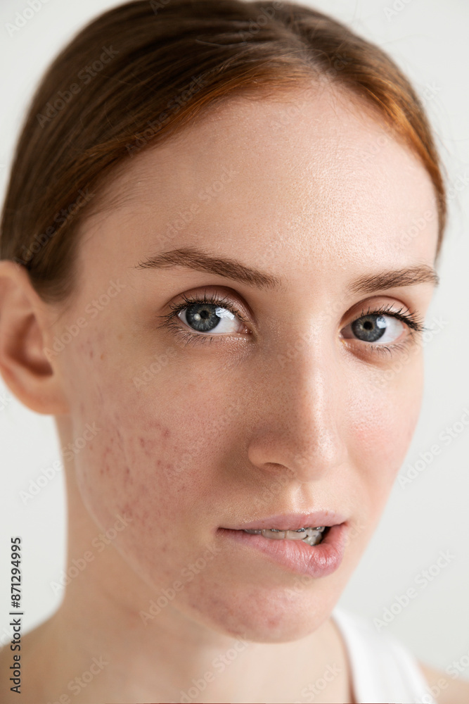 Serious Young Woman with Acne Serious Young Woman with Acne