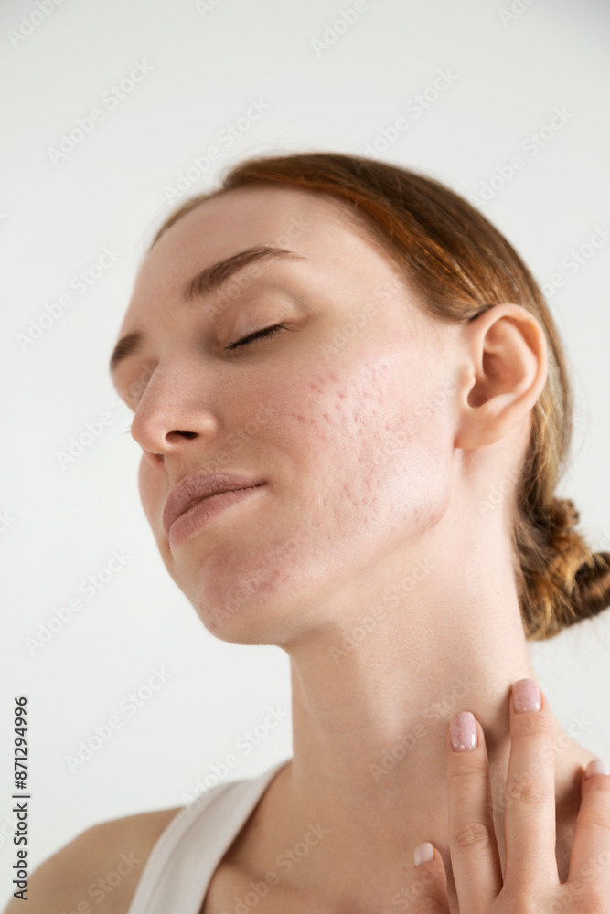 Woman with Acne and Closed Eyes Touching Neck Woman with Acne and Closed Eyes Touching Neck