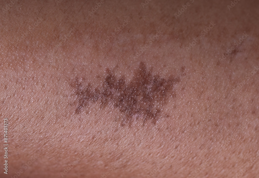 Fototapeta premium Close up hypertrophic scar at the leg