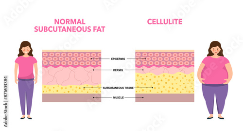 Cellulite concept, excess fat in human body. Overweight and increase subcutaneous fat diagram. Obese woman, diet program. Skin layers structure epidermis, dermis and hypodermis vector illustration.