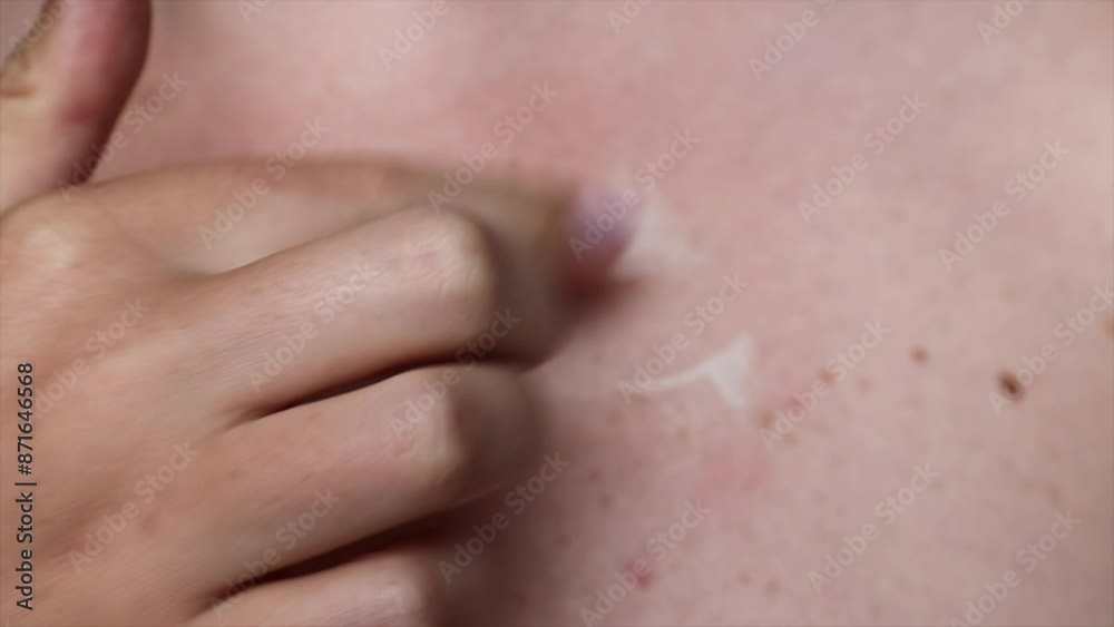 Apply the cream to pigmented skin with moles and freckles.