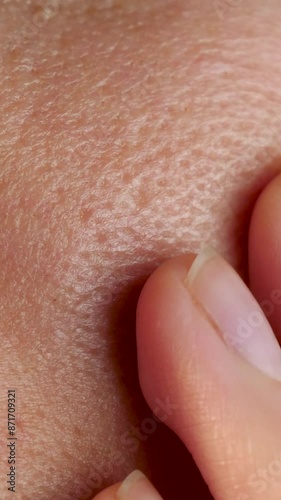 short vertical skin texture large pores. oily troubled facial on large pores. removal pores
