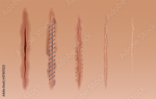 Set of healing wounds, skin scars, stitched gash and cuts. Realistic surgical sutures, stitched wounds at different healing stages isolated on human skin background