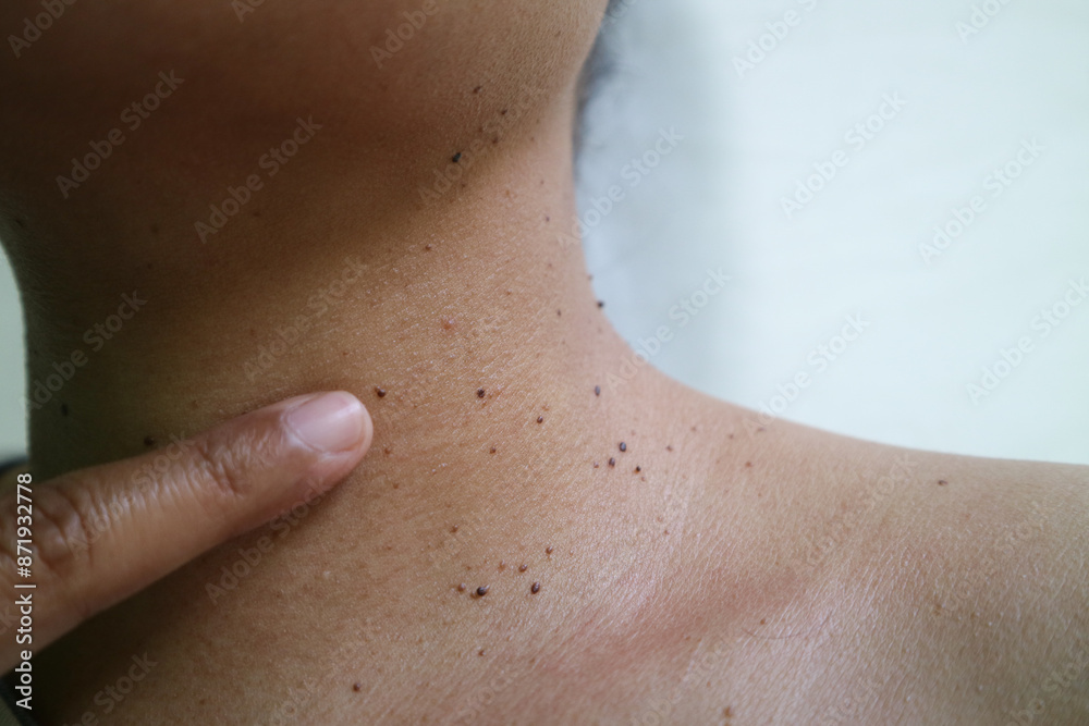 Fototapeta premium Close up the skin tags on woman's neck skin. Acrochordon. Skin tags are benign, non-cancerous tumors of the skin. usually harmless and painless. Health care concept.