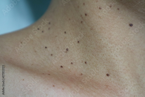 Close up the skin tags on woman's neck. Acrochordon. Health care concept. Woman showing her neck's skin with skin tag. photo