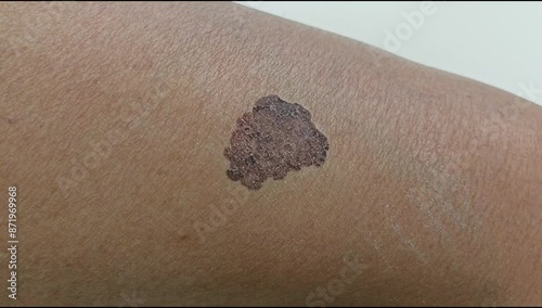 melanoma - a malignant tumor of the skin. A big mole on skin. Moving, and zoom in.