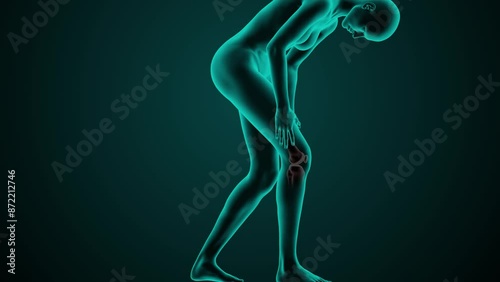 X-ray scan of a woman's knee joint. Knee pain caused by trauma or inflammation. Medically accurate 3D animation