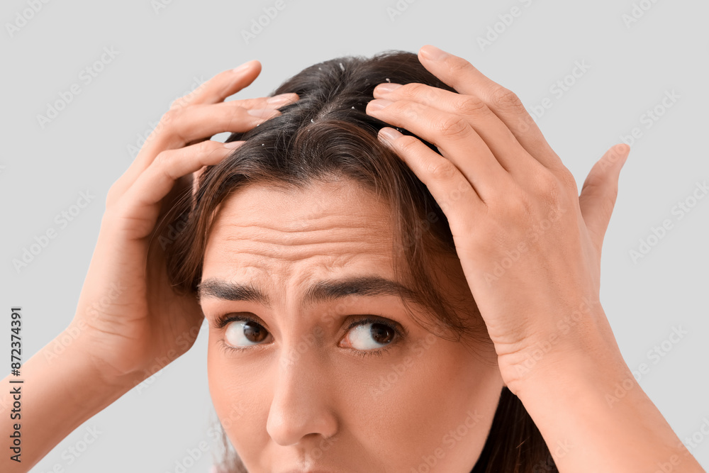Worried young woman with dandruff on light background, closeup