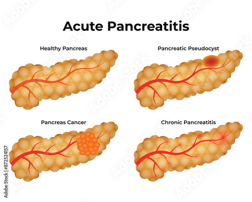 Acute Pancreatitis Science Design Vector Illustration Diagram