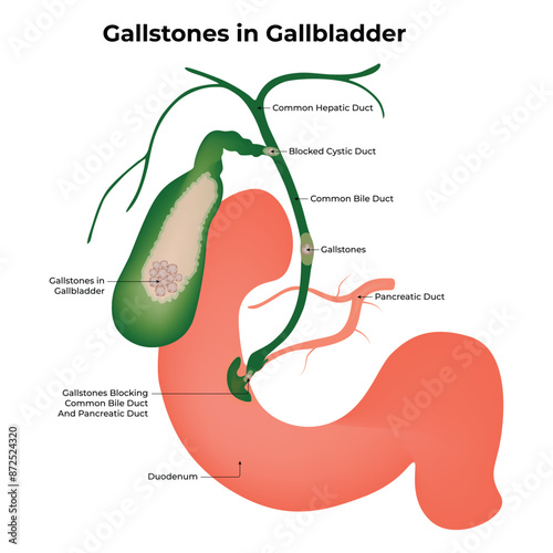 Gallstones in Gallbladder Science Design Vector Illustration Diagram