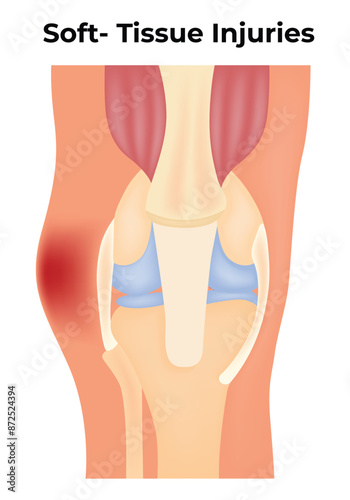 Soft Tissue Injuries Science Design Vector Illustration  Diagram