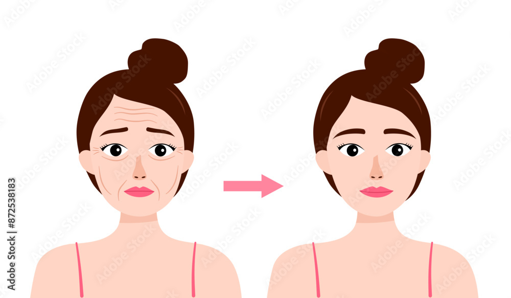 Woman face wrinkles before and after skin care treatment in flat design. Anti-aging therapy. Woman face wrinkles before and after skin care treatment in flat design. Anti-aging therapy.
