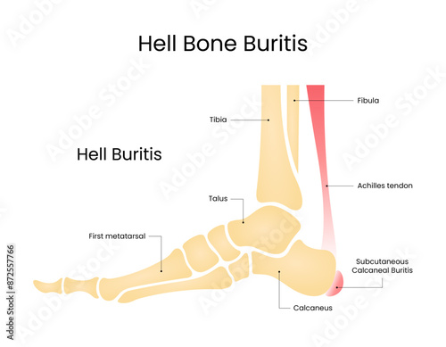 Symptoms of Subcutaneous Calcaneal Bursitis