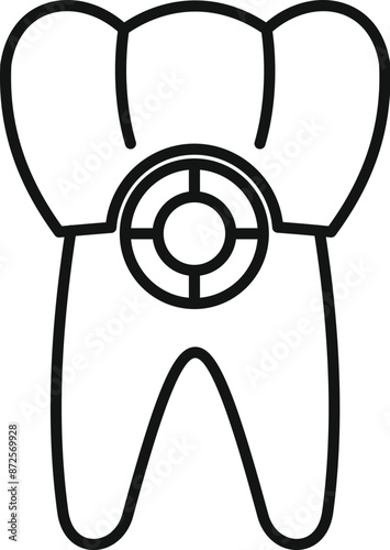 Line drawing of a tooth receiving a dental implant