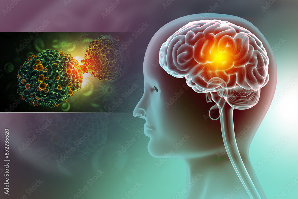 Obraz premium Brain cancer, showing presence of tumor inside brain. 3d illustration