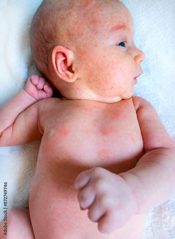 baby allergy skin. child dermatitis symptom problem rash. suffering atopic symptom on skin cheeks. concept child health. allergic reaction miliaria, prickly heat on baby's back.