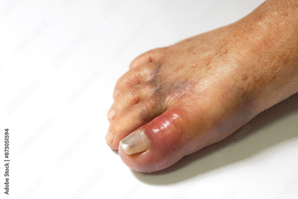 Swollen toe with gout inflammation. Gout is a form of inflammatory arthritis that occurs when uric acid crystals accumulate in the joints, causing severe pain, swelling, and redness.