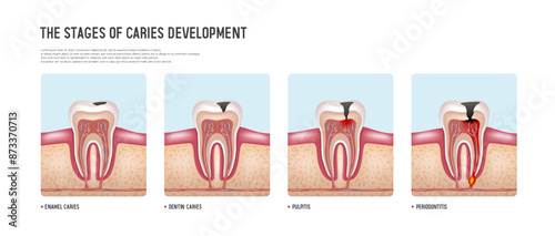 Stages of caries development. Vector illustration.