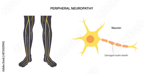 Peripheral neuropathy medical poster