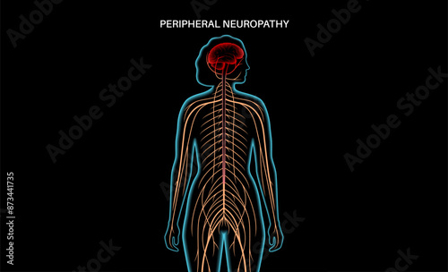 Peripheral neuropathy medical poster