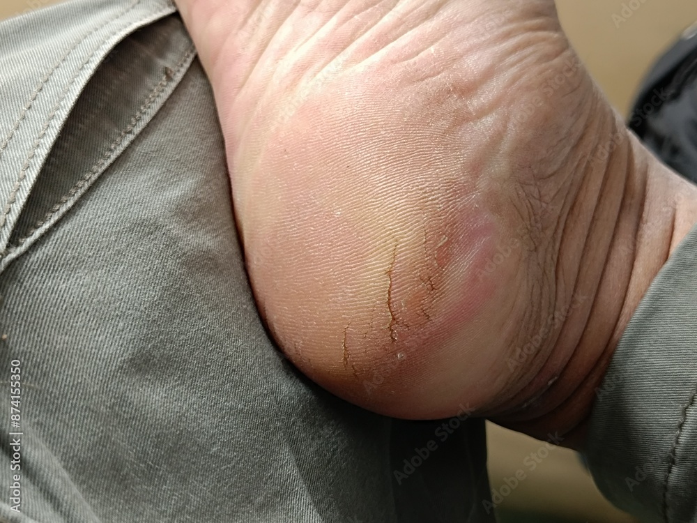 Naklejka premium close up of the cracked heel of the man's foot
