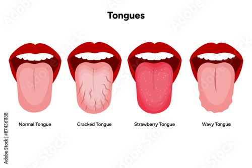 Normal, cracked, strawberry and wavy tongue 