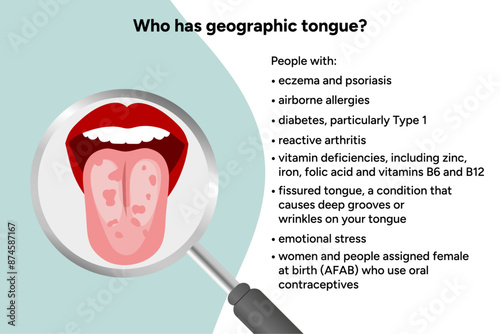 Geographic tongue, causes, medical illustration 