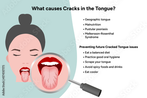 Cracks tongue, causes, medical illustration 