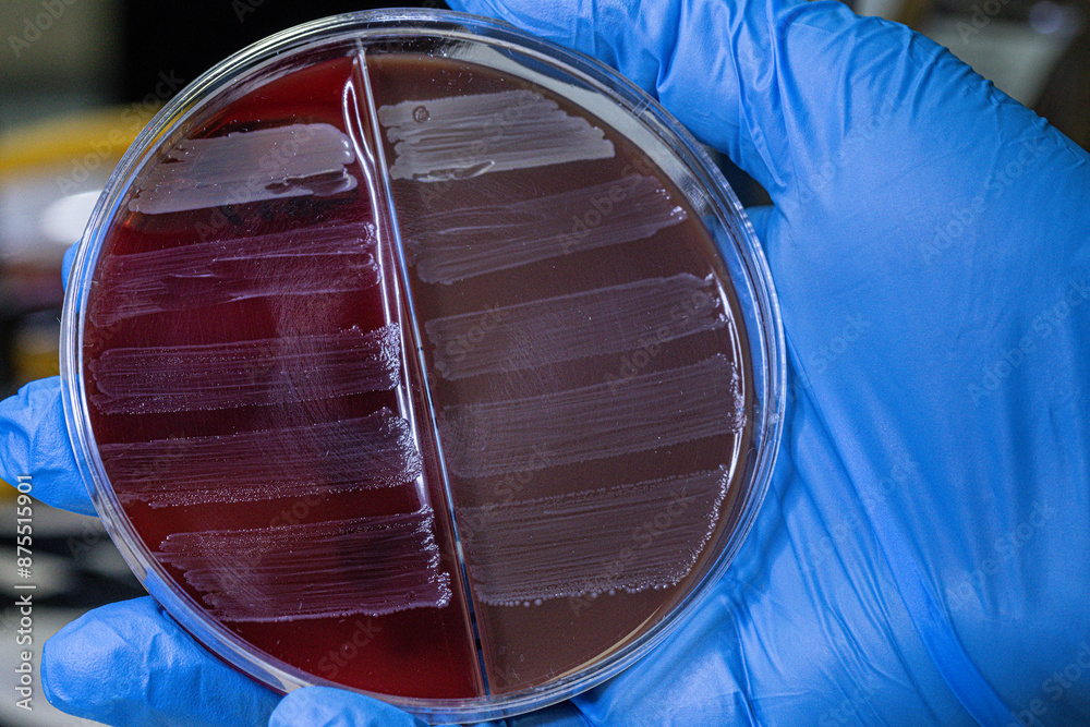 Medical themes: Hand holds a Petri dish with a culture of enterococcus bacteria Sp.