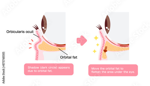 How to remove dark circles under the eyes with Lower blepharoplasty (Transconjunctival blepharoplasty)