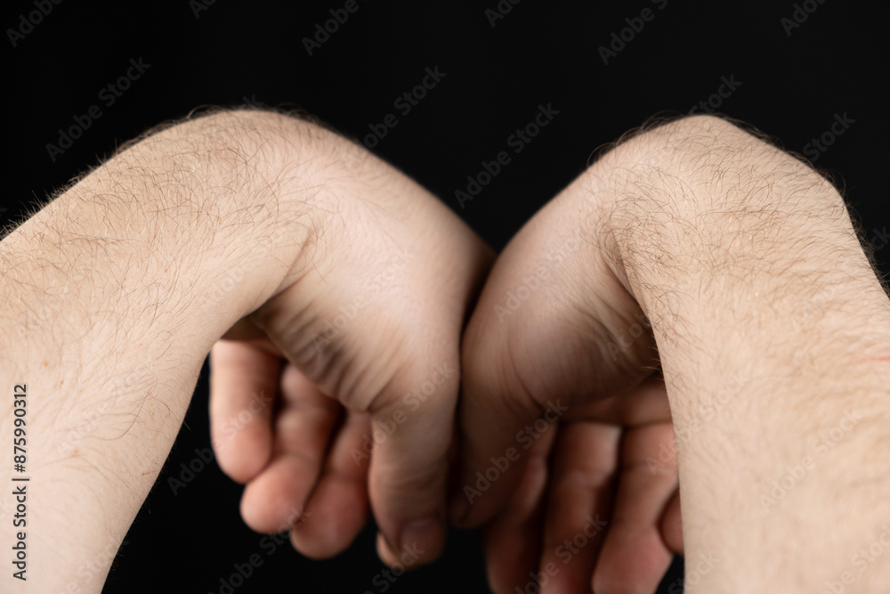 Comparison of healthy arm and arm with wrist ganglion cyst. Comparison of healthy arm and arm with wrist ganglion cyst.