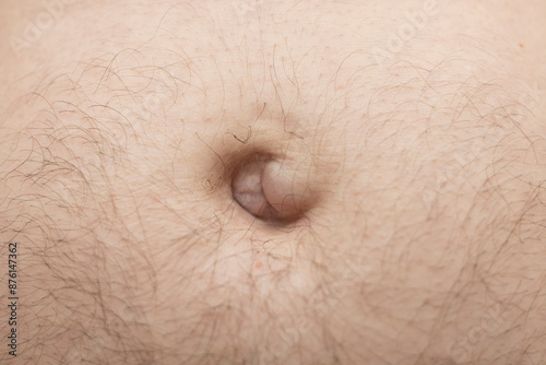 Lump in Belly Button - hernia, an inflammatory condition - possible cancer