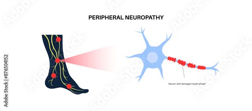 Peripheral neuropathy medical poster