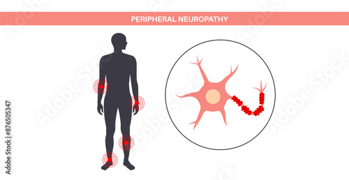 Peripheral neuropathy medical poster