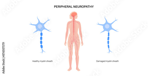 Peripheral neuropathy medical poster