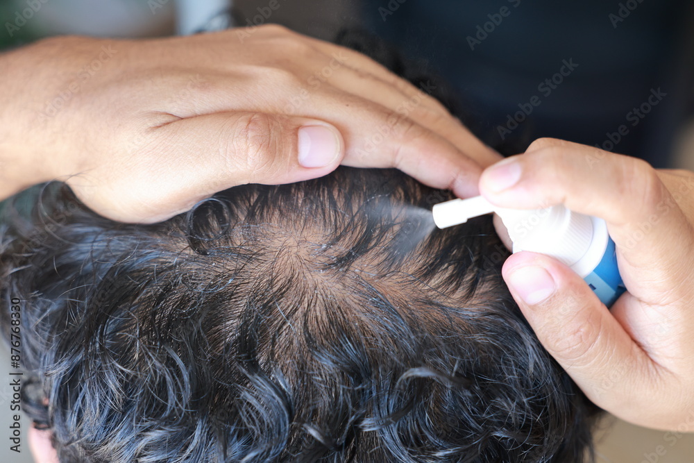 Asian men use serum spray to maintain strong hair and prevent breakage. Man with worry and touching on his head to show a bald head. Hair root nourishment. concept of healthcare, treat, medicine.