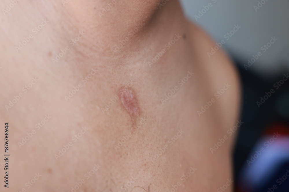 Fototapeta premium Asian man has blisters on his chest from oil splashes while cooking. Pityriasis rosea disease on the chest and neck on an isolated background. concept of healthcare, treat, medicine, injured.