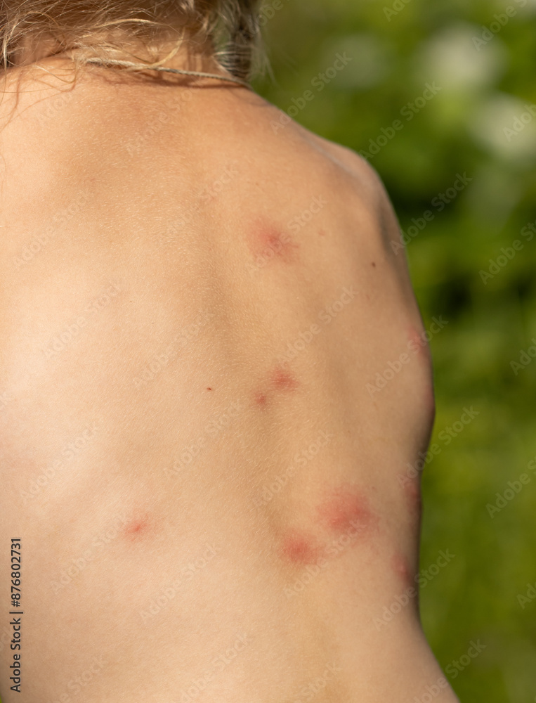 mosquito bites on a child's back as a background. mosquito bites on a child's back as a background.