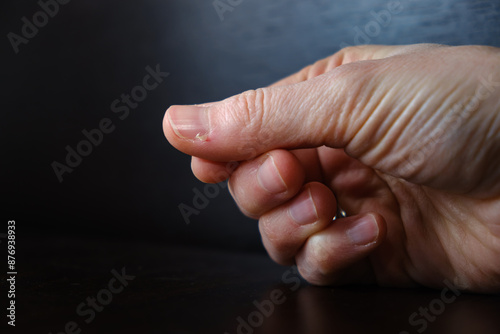 Bleeding hangnail of a female hand on dark background close-up. Ill injury. Ripped off skin. Concept of bad habits, biting and ripping off hangnails on fingernails. High quality photo