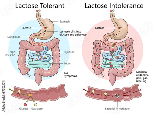 lactose tolerance and intolerance in the digestive system, illustrating symptoms and processes in intestines diagram hand drawn schematic raster illustration. Medical science educational illustration